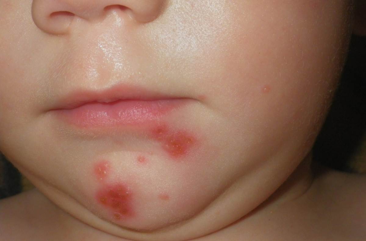 герпес на губах у ребенка 2 года