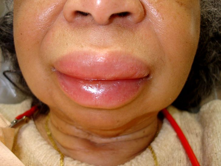 Отек Квинке отек квинке код по мкб