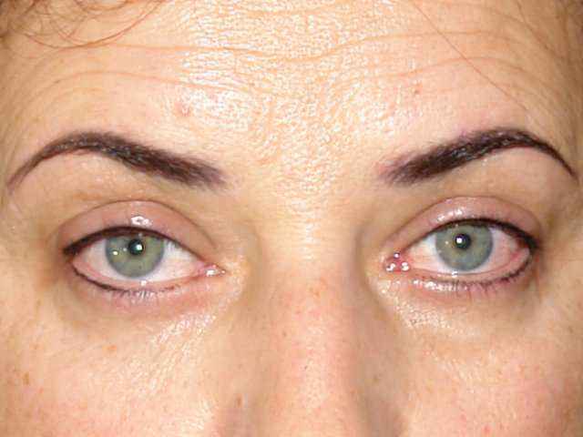 Причины отеков верхних век по утрам Отеки