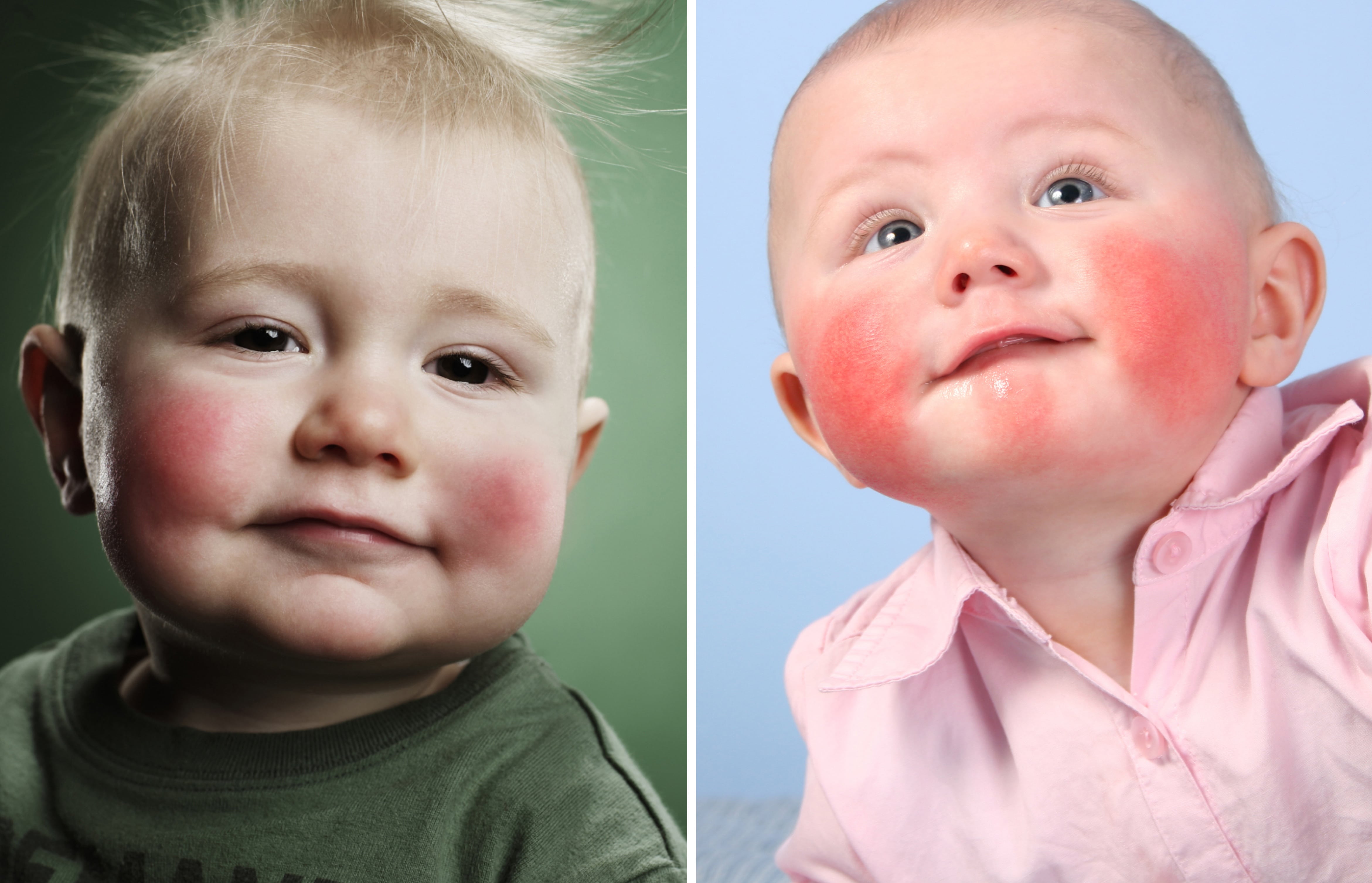 Аллергия у ребенка после одного года thumbnail