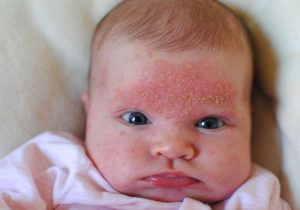 шелушиться кожа у новорожденного на лице