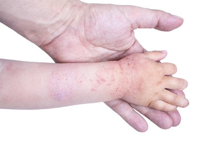 На что может аллергия у ребенка после года thumbnail