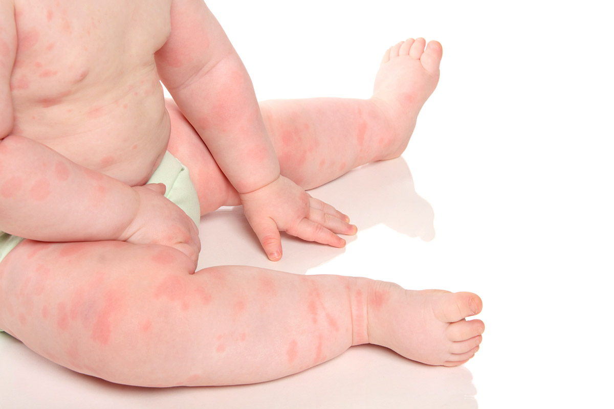 Чем лечить аллергию у ребенка годовалого ребенка thumbnail