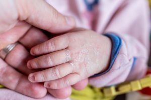шелушиться кожа у новорожденного на руках