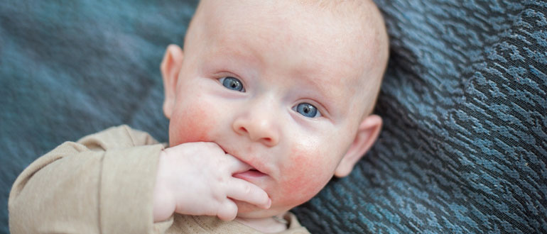 Почему шелушится кожа на теле у новорожденного? у новорожденного шелушиться кожа на теле