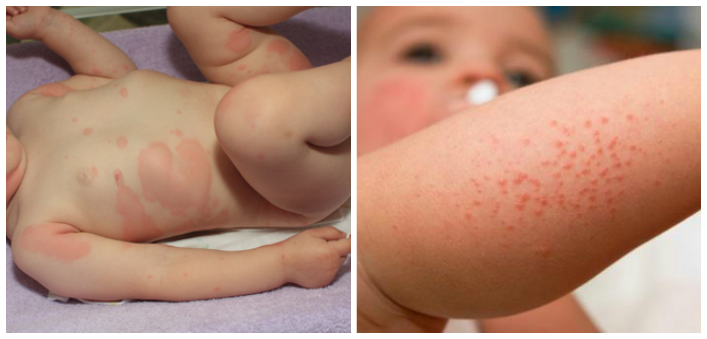 Аллергия у ребенка в год где thumbnail