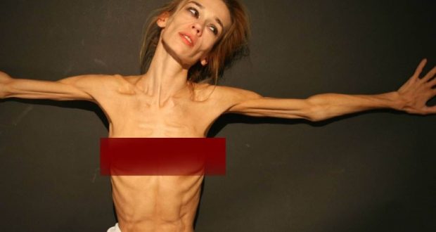 Анорексия у девочки: что это за болезнь и как ее лечить Анорексия что это за болезнь у девочки