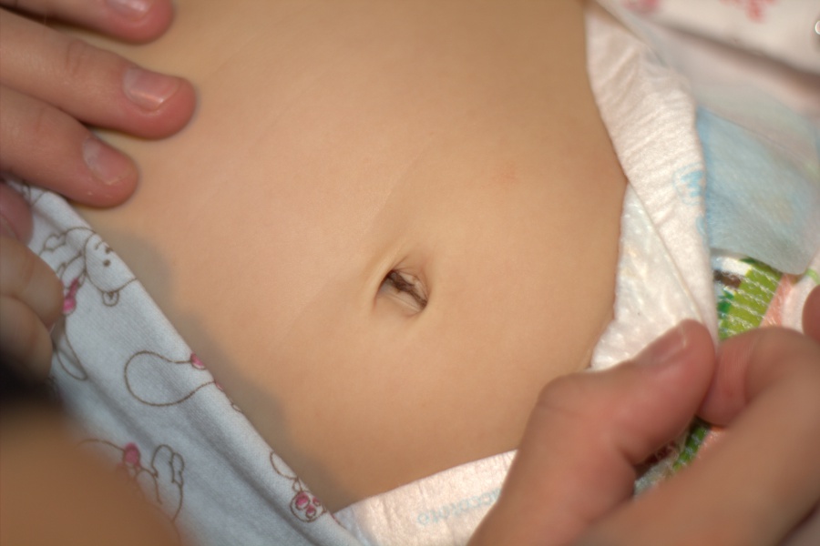 болезни пупка у новорожденных фото 1