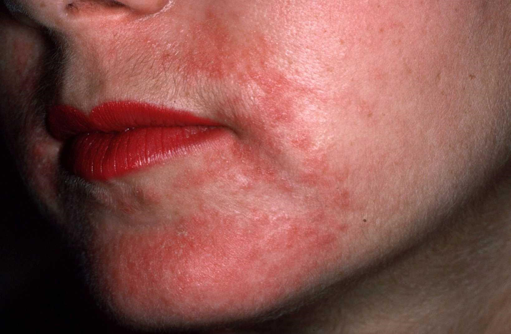 Пероральный дерматит на лице