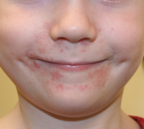 Пероральный дерматит на лице у детей