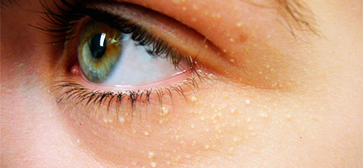 Как избавиться от жировиков на веках Жировики на веках глаз