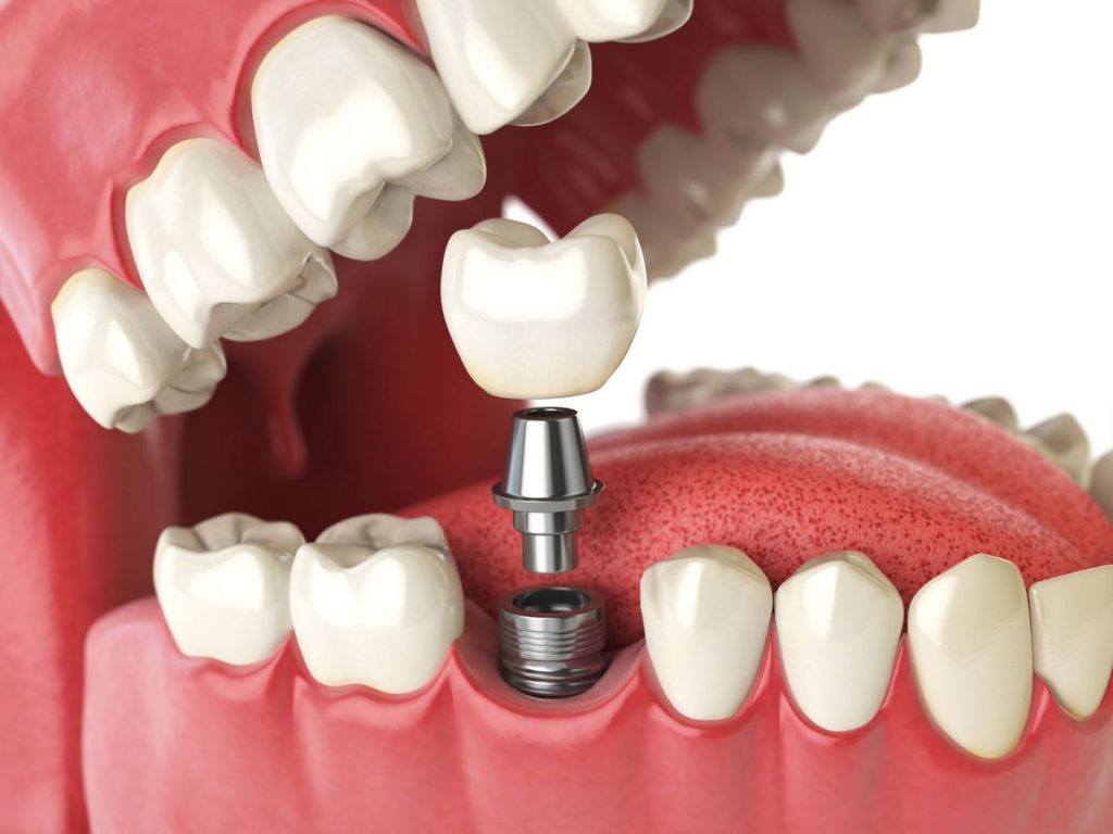двухэтапная имплантация зуба