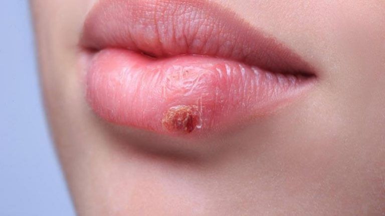 Лечение герпеса на губах герпес на губе