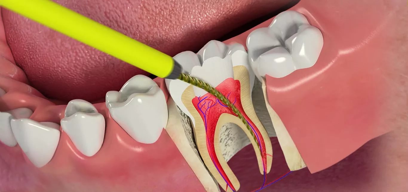 После лечения кариеса зуб болит при нажатии твердой пищей