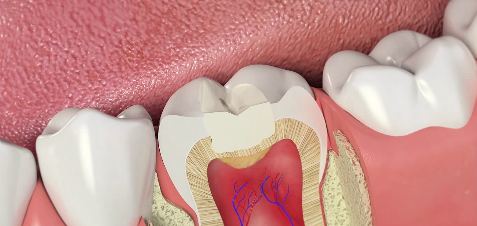 После лечения кариеса зуб болит при нажатии твердой пищей thumbnail