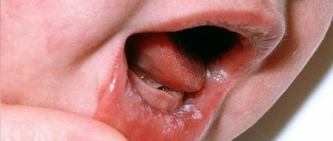 Молочница у грудничка во рту: симптомы и лечение Молочница у грудничка во рту