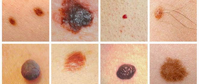 Как определить доброкачественная или злокачественная родинка Как определить злокачественная родинка или нет