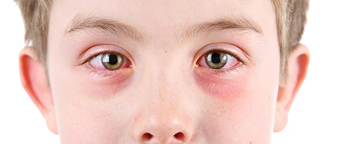 Противоаллергические капли для глаз для детей Противоаллергические капли для глаз