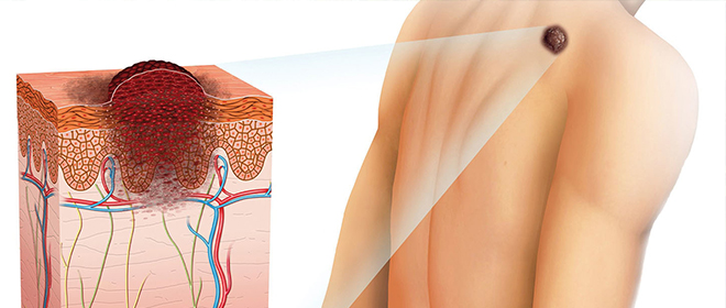 Кожная болезнь невус