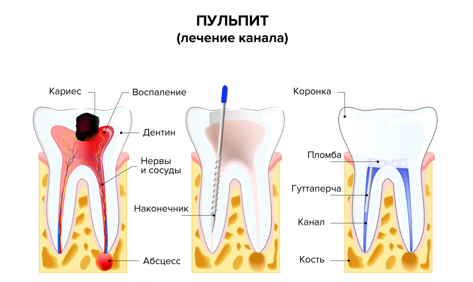Депульпация зуба