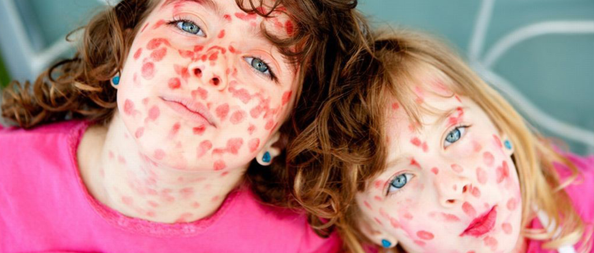Краснуха у детей: лечить или избегать? Краснуха у детей