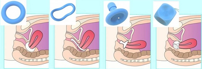 Пессарий при беременности