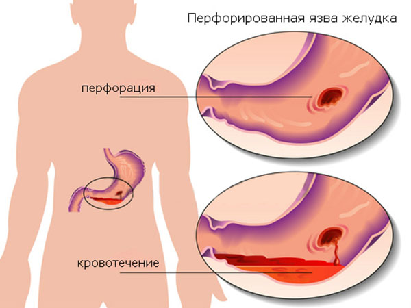 Язва с кровотечением