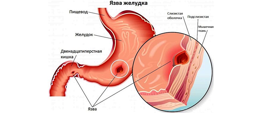 Язвенная болезнь