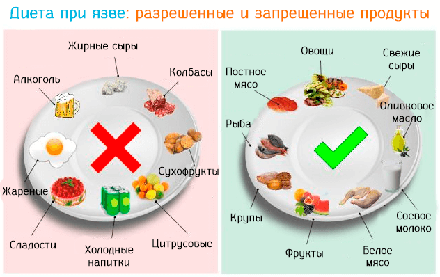 Запрещенные продукты при язве