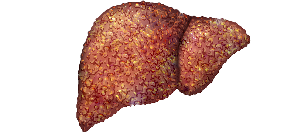 Фиброз печени: лечение и профилактика Фиброз печени