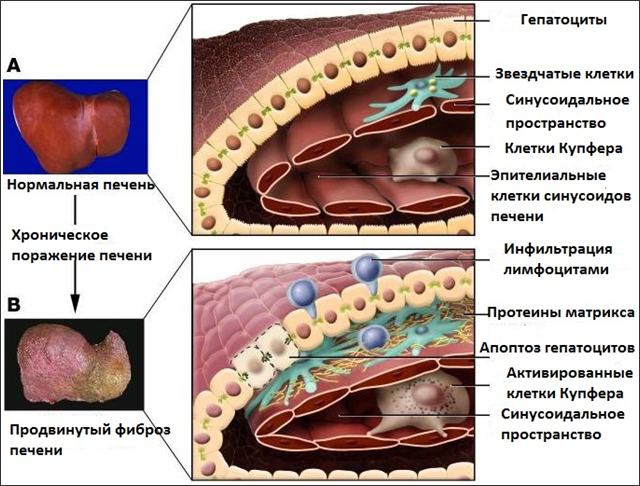 Фиброз печени