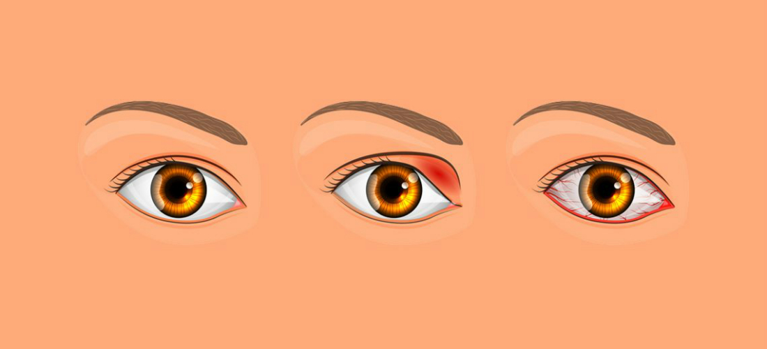 Ячмень на глазу: что это такое и почему он появляется?