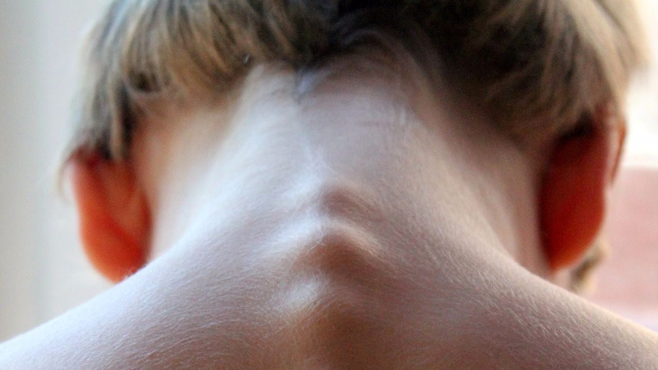 Симптомы и лечение остеохондроза шейного отдела позвоночника шея