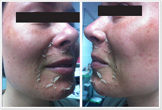 Шелушение кожи после пилинга