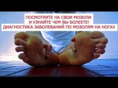 Диагностика по мозолям в 12 местах стопы болезней человека