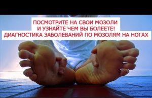 Диагностика по мозолям в 12 местах стопы болезней человека