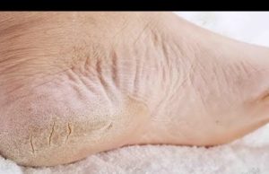 Натоптыши и трещины на пятках нам не нужны! Вот 10 домашних средств для идеальных ножек!