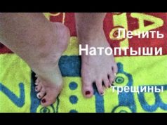 Средство от натоптышей на ногах, мозолей