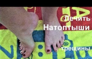 Средство от натоптышей на ногах, мозолей