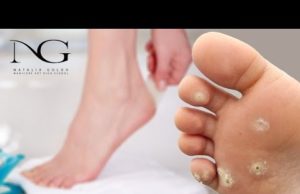 Как отличить бородавку от мозоли: в чем разница