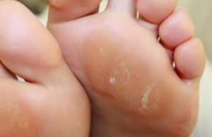 Натоптыши на ногах: причины, симптомы, диагностика и лечение