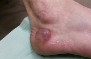 Можно ли протыкать мозоль на ноге — правила и рекомендации