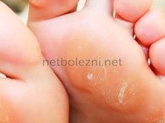 Мазь для лечения натоптышей на ступнях