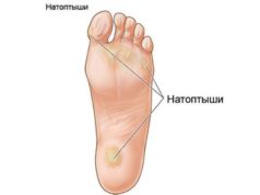 Натоптыши (сухие мозоли) на пальцах ног, пятках, ступнях, подошве – причины, симптомы и удаление натоптышей на ногах