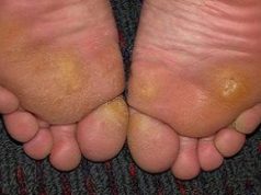 Натоптыши: фото, причины, лечение