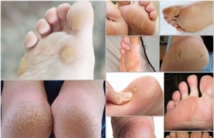 Как избавиться от натоптышей на ногах: причины, симптомы, лечение (профессиональное удаление, аптечные средства и народные рецепты ), профилактика