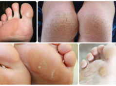 Как убрать натоптыши на ногах в домашних условиях: быстрое избавление медикаментозными и народными средствами