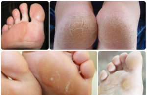 Как убрать натоптыши на ногах в домашних условиях: быстрое избавление медикаментозными и народными средствами