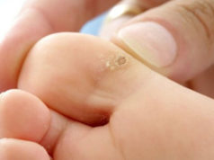 Натоптыши на пальцах ног: причины, симптоматика, лечение