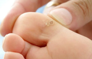 Натоптыши на пальцах ног: причины, симптоматика, лечение